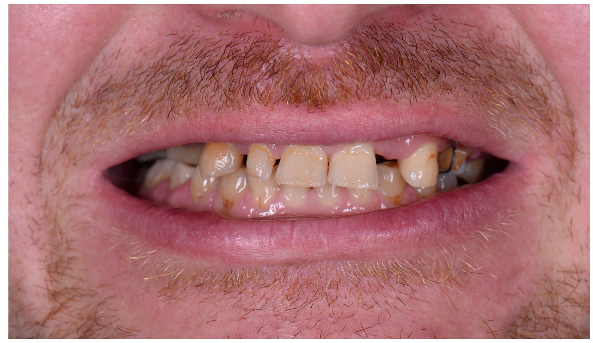 Before photo: Man's mouth showing worn, discolored teeth with gaps