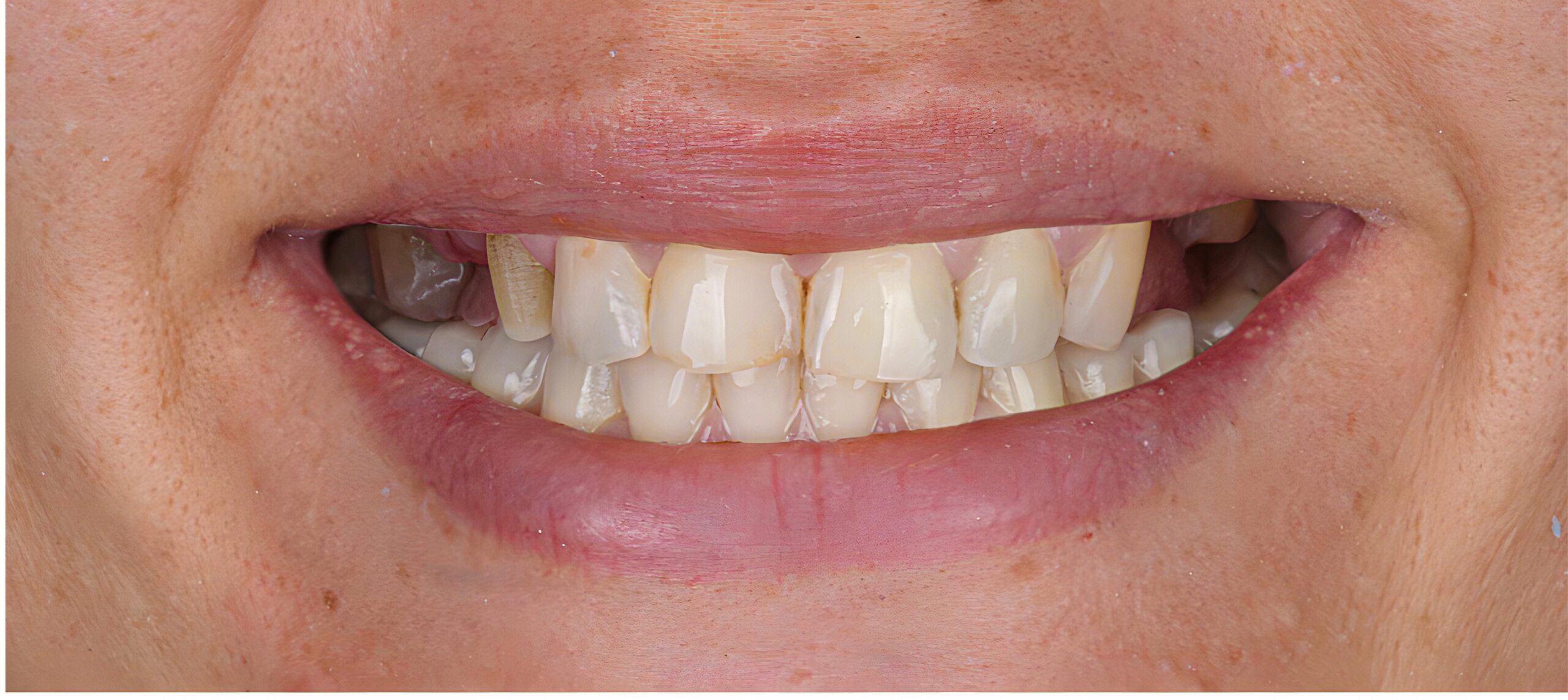 Close-up of teeth showing missing tooth on left side with partial smile
